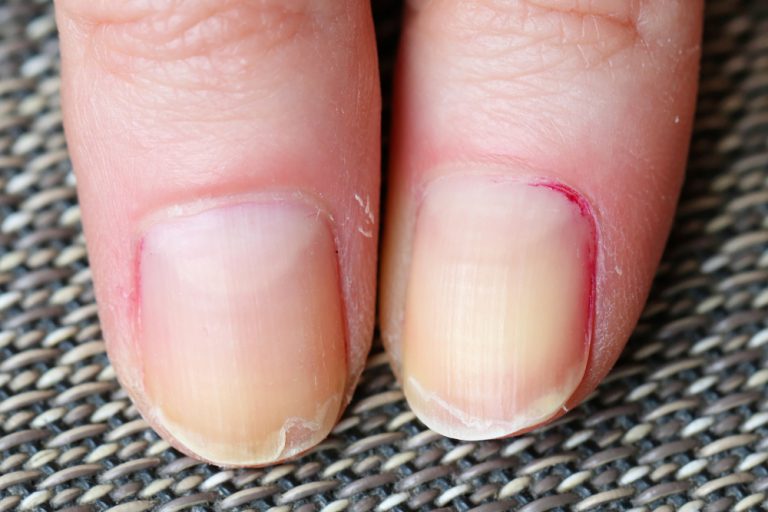 Pourquoi vos ongles sont-ils bombés