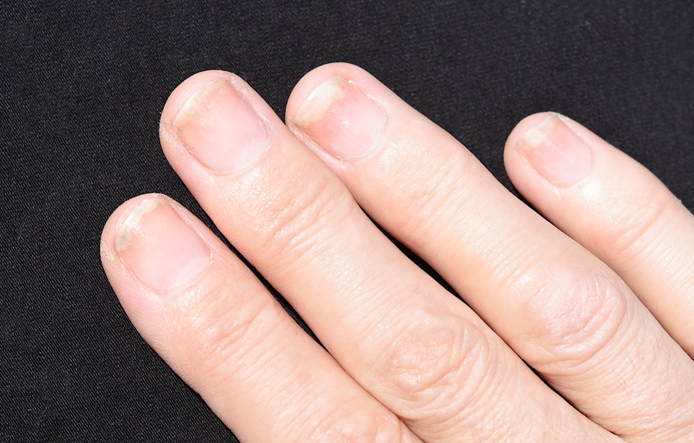 Quelles sont les causes des maladies de l'attache de l'ongle et comment apporter les soins appropriés