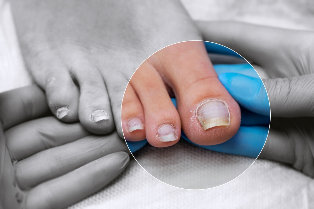 Épaississement des ongles de pied : causes et traitements